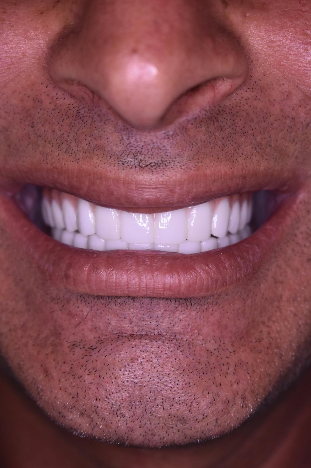 After — restorative care at Cura Smiles