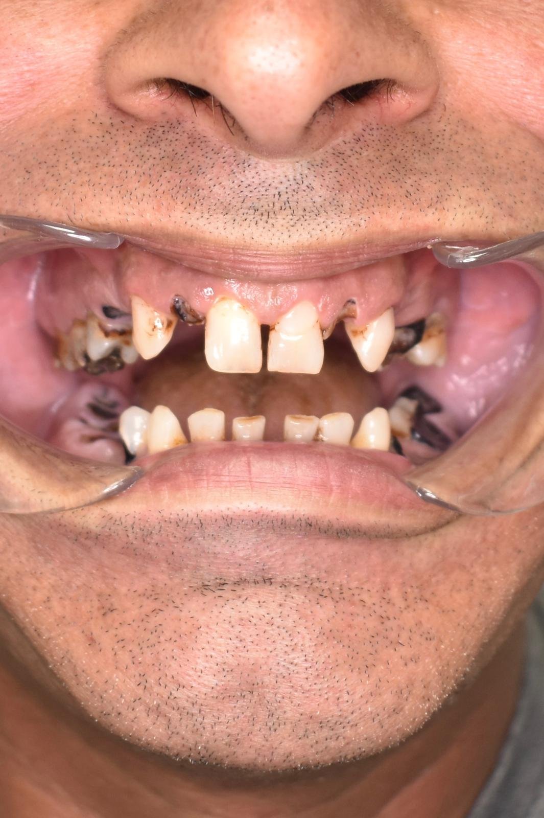 Before — restorative care at Cura Smiles