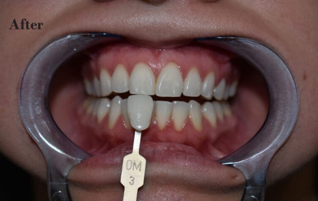 After — full oral health restoration at Cura Smiles