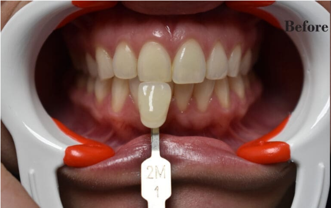 Before — full oral health restoration at Cura Smiles