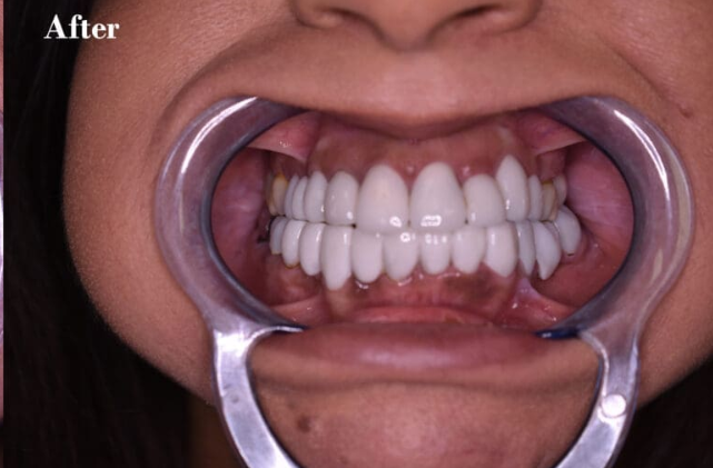 After — comprehensive dental care at Cura Smiles